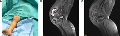 A rare case of long-term joint swelling caused by pigmented villonodular synovitis in a 3-year-old girl: a case report